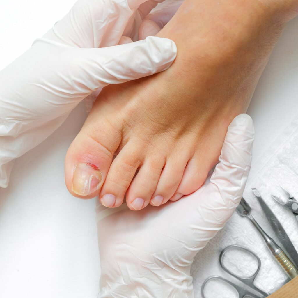 Pedicure, podologist. Patient on medical pedicure procedure, nail disease, cholesis detachment of th